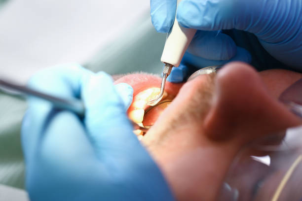 Best Emergency Dentist for Lost Fillings or Crowns in Hinesville, GA
