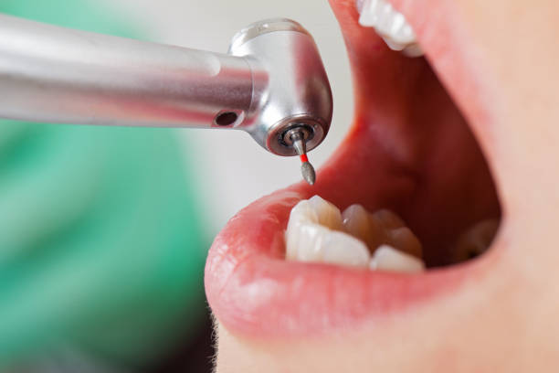 Best Emergency Dental Extractions in Hinesville, GA